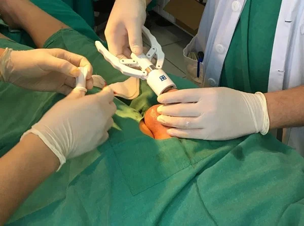 máy Surkon được dùng trong phẫu thuật cắt bao quy đầu máy Surkon được dùng trong phẫu thuật cắt bao quy đầu