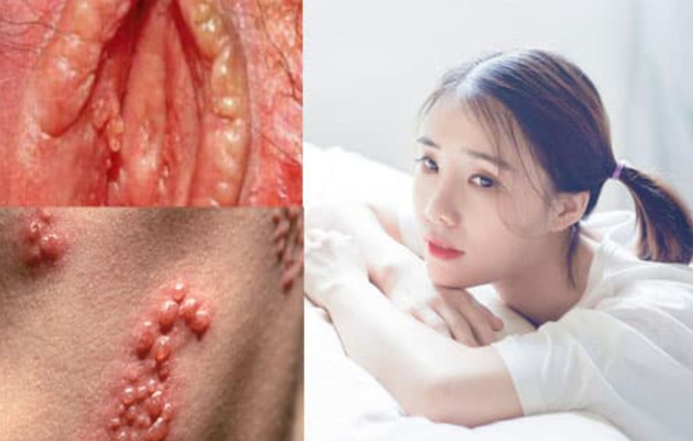 hình ảnh bệnh lậu ở nữ giới