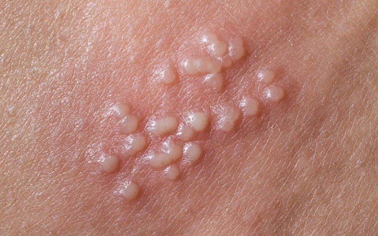 hình ảnh mụn rộp sinh dục hình ảnh mụn rộp sinh dục