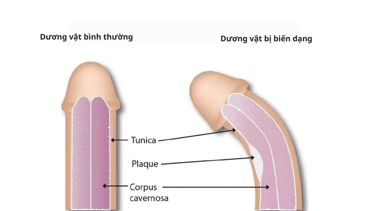 dài bao quy đầu làm dị dạng dương vật dài bao quy đầu làm dị dạng dương vật