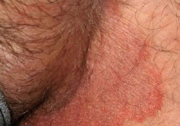 hãy can thiệp y tế khi các triệu chứng ngứa dương vật có xu hướng nghiêm trọng hơn