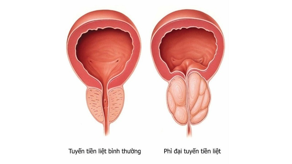 phì đại tuyến tiền liệt có thể là nguyên nhân gây ra đi tiểu buốt kèm máu phì đại tuyến tiền liệt có thể là nguyên nhân gây ra đi tiểu buốt kèm máu
