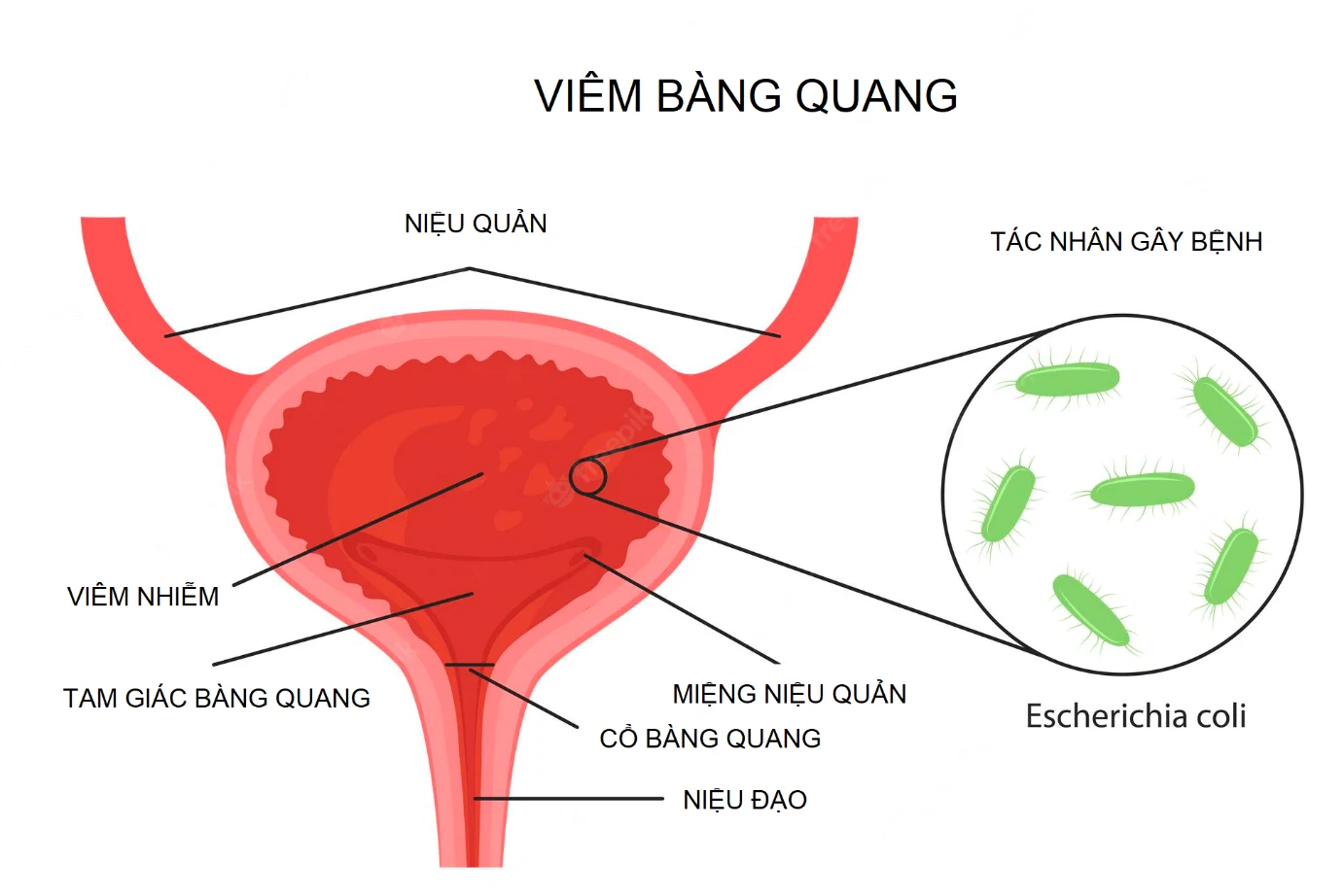 nguyên nhân gây viêm bàng quang do vi khuẩn Escherichia coli nguyên nhân gây viêm bàng quang do vi khuẩn Escherichia coli