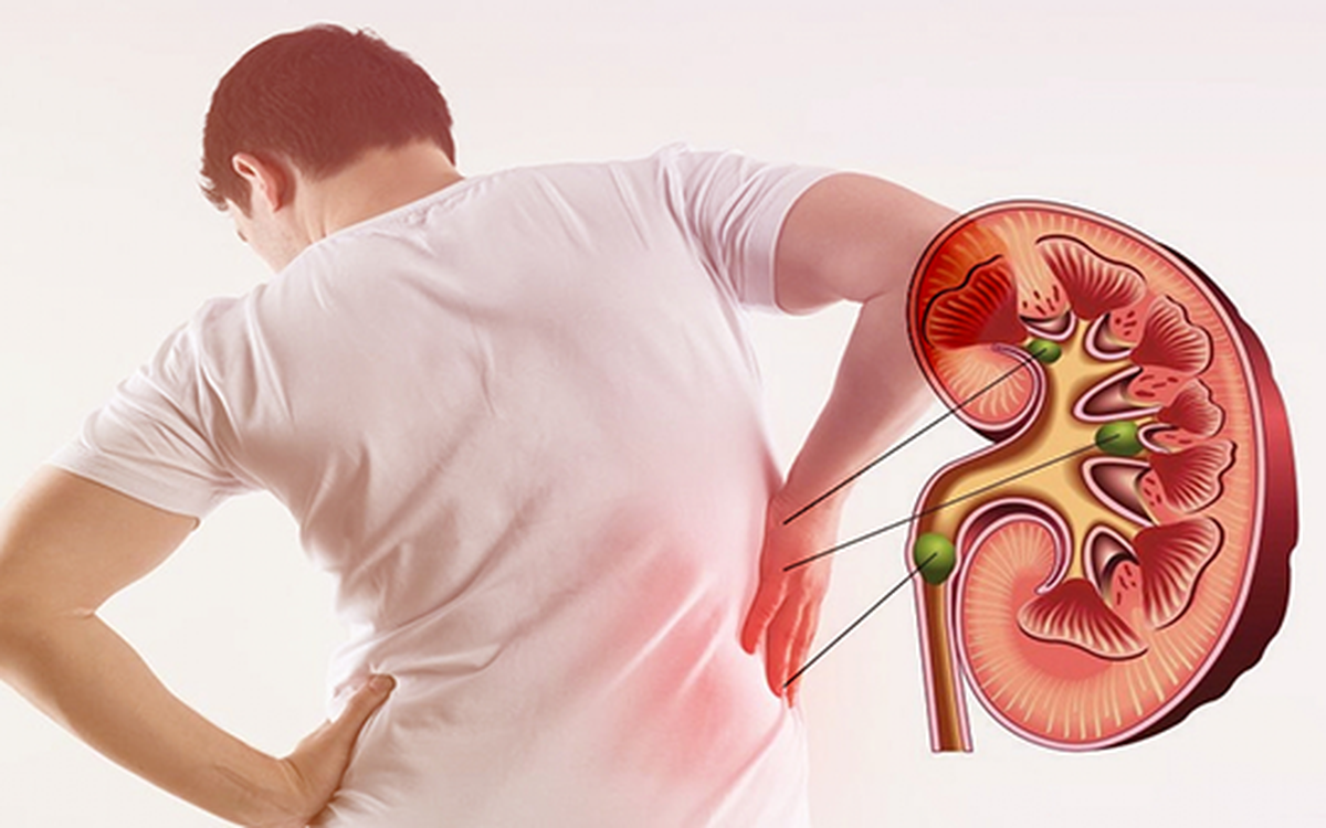 đi tiểu nhiều lần có thể là dấu hiệu của bệnh sỏi thận