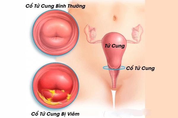 viêm cổ tử cung có thể do viêm âm đạo tiến triển