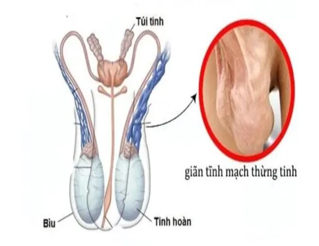 giãn tĩnh mạch thừng tinh là bệnh lý rất hay gặp hiện nay