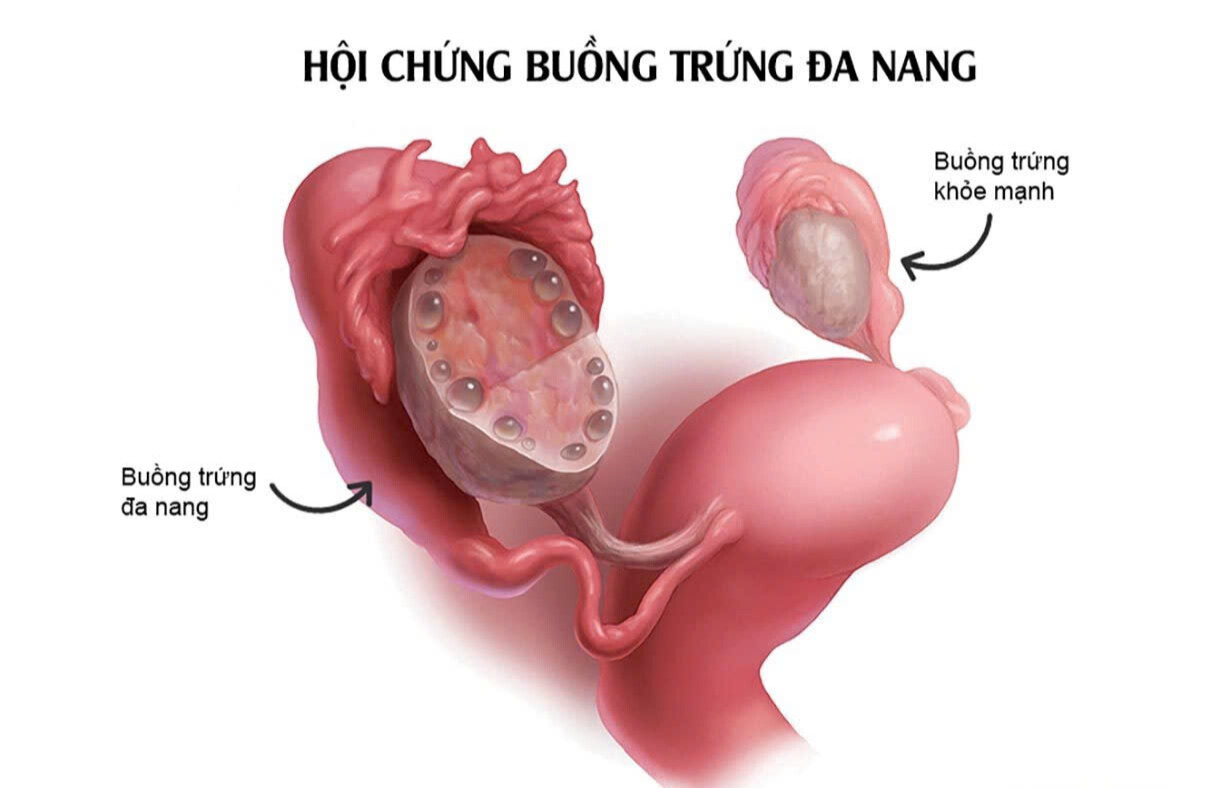 polyp tử cung có thể là nguyên nhân gây ra hội chứng buồng trứng đa nang