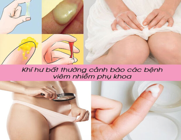 khí hư bất thường có thể là dấu hiệu viêm lộ tuyến cổ tử cung