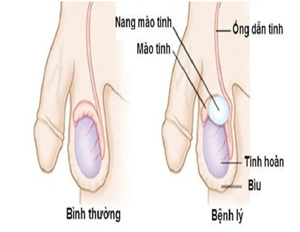u nang mào tinh hoàn dễ nhầm lẫn với ung thư tinh hoàn