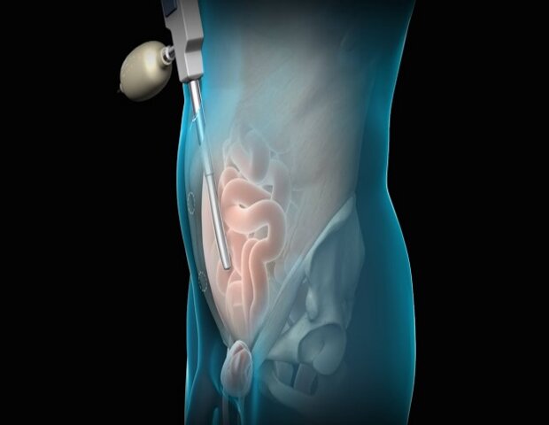 đóng thoát vị bẹn là một cách chữa viêm túi tinh 