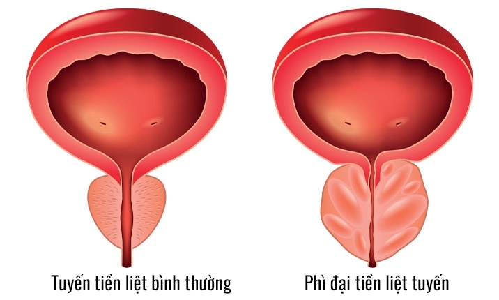 nam giới bị đau khi đi tiểu có thể do bị viêm hoặc phì đại tuyến tiền liệt