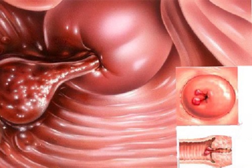 hình ảnh polyp cổ tử cung