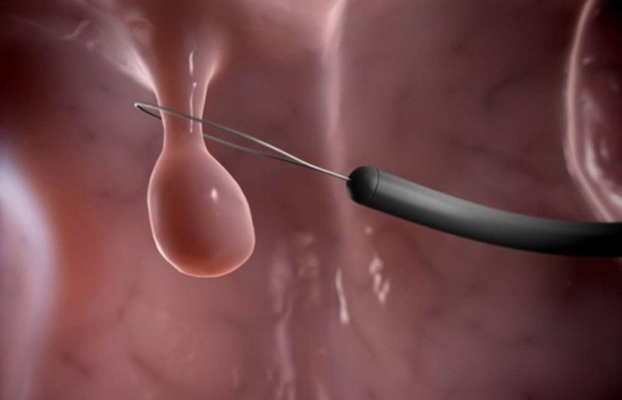 phẫu thuật là một trong những phương pháp điều trị polyp cổ tử cung hiệu quả