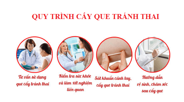 quy trình cấy que tránh thai nên được thực hiện cẩn thận
