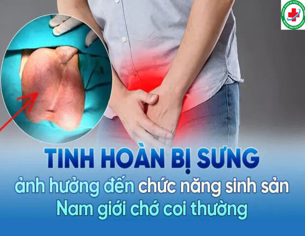 hiện tượng khi một bên bìu phải (túi da chứa tinh hoàn) bị phình to