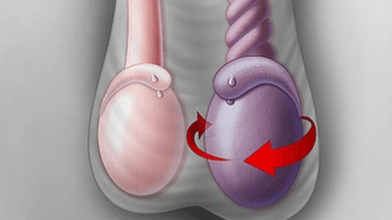 một bên tinh hoàn bị đau nhức trong khi bên còn lại vẫn bình thường