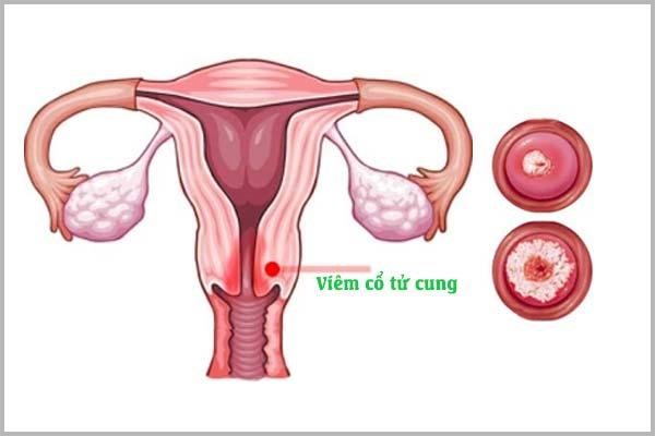Viêm cổ tử cung: Dấu hiệu nhận biết và phương pháp điều trị