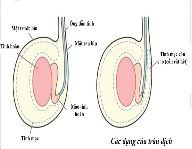 nguyên nhân chính dẫn đến tình trạng sưng bìu bên trái