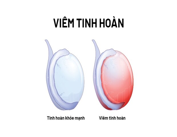 viêm tinh hoàn ở nam giới