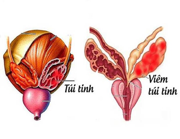 viêm túi tinh do nhiều nguyên nhân gây ra