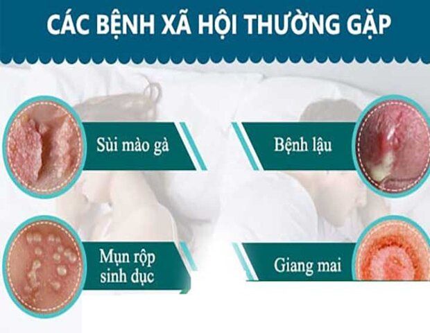 bệnh xã hội là nguyên nhân khiến “cậu nhỏ” nổi mụn trắng
