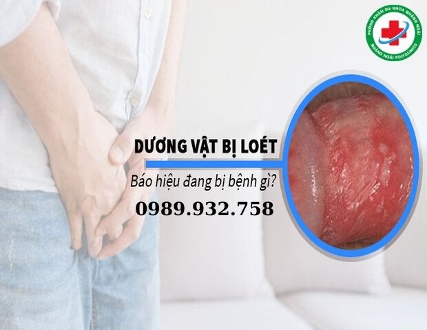 nếu xuất hiện vết loét trên thân dương vật nam giới cần đi khám ngay lập tức