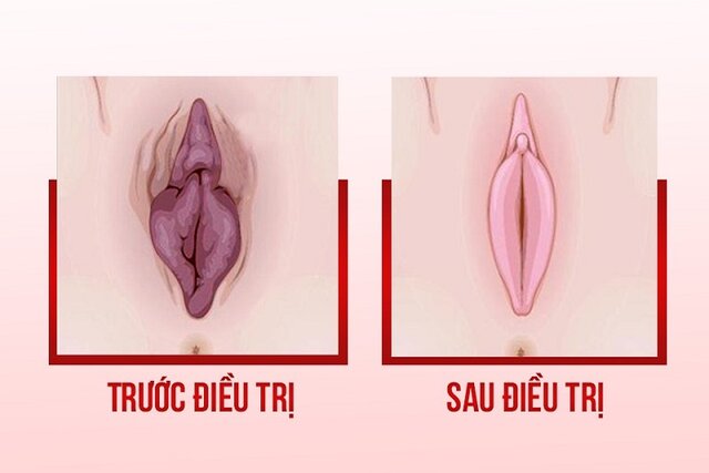 vùng kín như được tái sinh sau khi tân trang