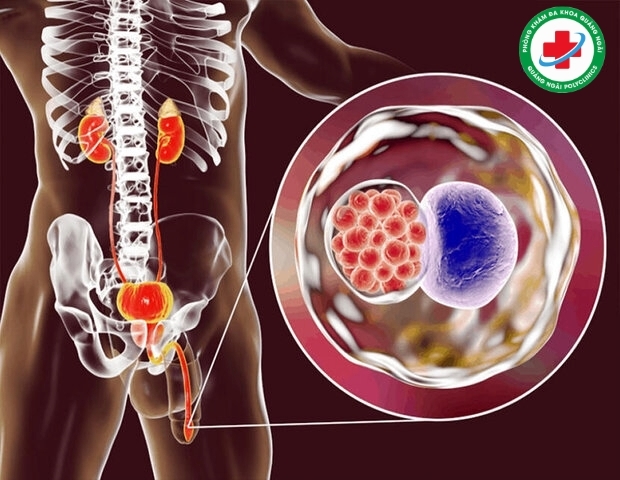 bệnh viêm niệu đạo ở nam giới