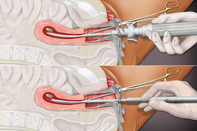  chân không là phương pháp phá thai an toàn được nhiều chị em tin tưởng lựa chọn