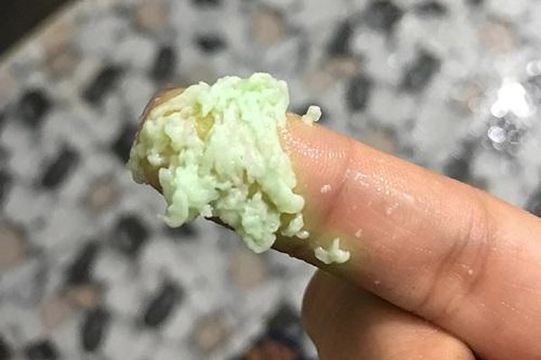 dịch tiết màu xanh bã đậu là dấu hiệu cảnh báo về bệnh viêm cổ tử cung 