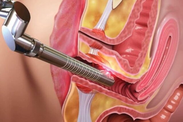 thiết bị đầu dò laser sẽ tỏa ra năng lượng 360 quanh thành âm đạo giúp se khít “cô bé”
