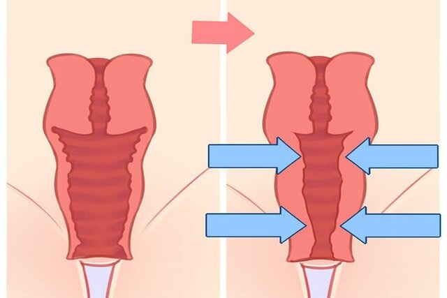 ống âm đạo được thắt chặt sau khi phẫu thuật thu hẹp âm đạo