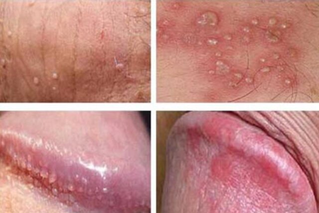 viêm rãnh bao quy đầu là bệnh viêm nhiễm dẫn đến tổn thương vùng bao quy đầu