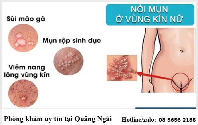 bị nổi mụn vùng kín